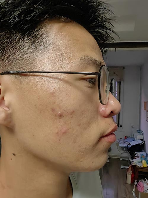 Closed Comedones Treatment Liquid